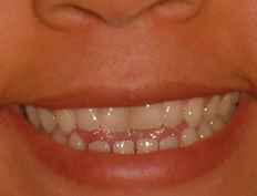 Young woman with a tongue thrusting habit:<br />Treatment with braces to close the bite