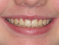 Young teenage girl treated with braces to create a beautiful smile