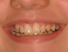 Young teenage girl treated with braces to create a beautiful smile