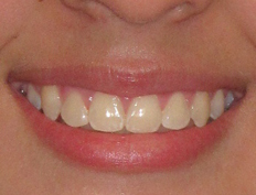 Young teenage girl with severe crowding:<br/ >Extraction treatment with braces to straighten her teeth