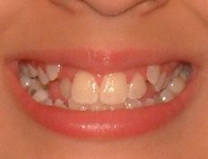 Young teenage girl with severe crowding:<br/ >Extraction treatment with braces to straighten her teeth