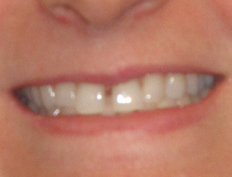 Woman with space between her front teeth:<br />Closed with Invisalign