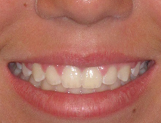 Girl treated with braces to create a beautiful smile