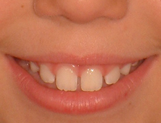 Girl treated with braces to create a beautiful smile