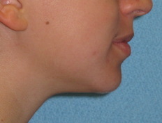 Teenage girl with lip tension:<br />Extraction treatment with braces resulting in better facial balance and relaxed lip posture