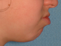Teenage girl with lip tension:<br />Extraction treatment with braces resulting in better facial balance and relaxed lip posture