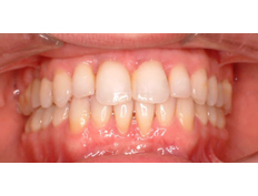 Young man with severe spacing between his teeth:<br />Treated with Invisalign to improve his quality of life