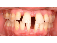 Young man with severe spacing between his teeth:<br />Treated with Invisalign to improve his quality of life