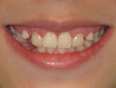 Successful Phase 1 (interceptive) treatment for an adolescent boy