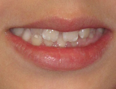 Successful Phase 1 (interceptive) treatment for an adolescent boy