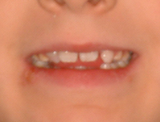 Adolescent boy treated with expansion, extractions and braces to straighten his teeth and improve his bite